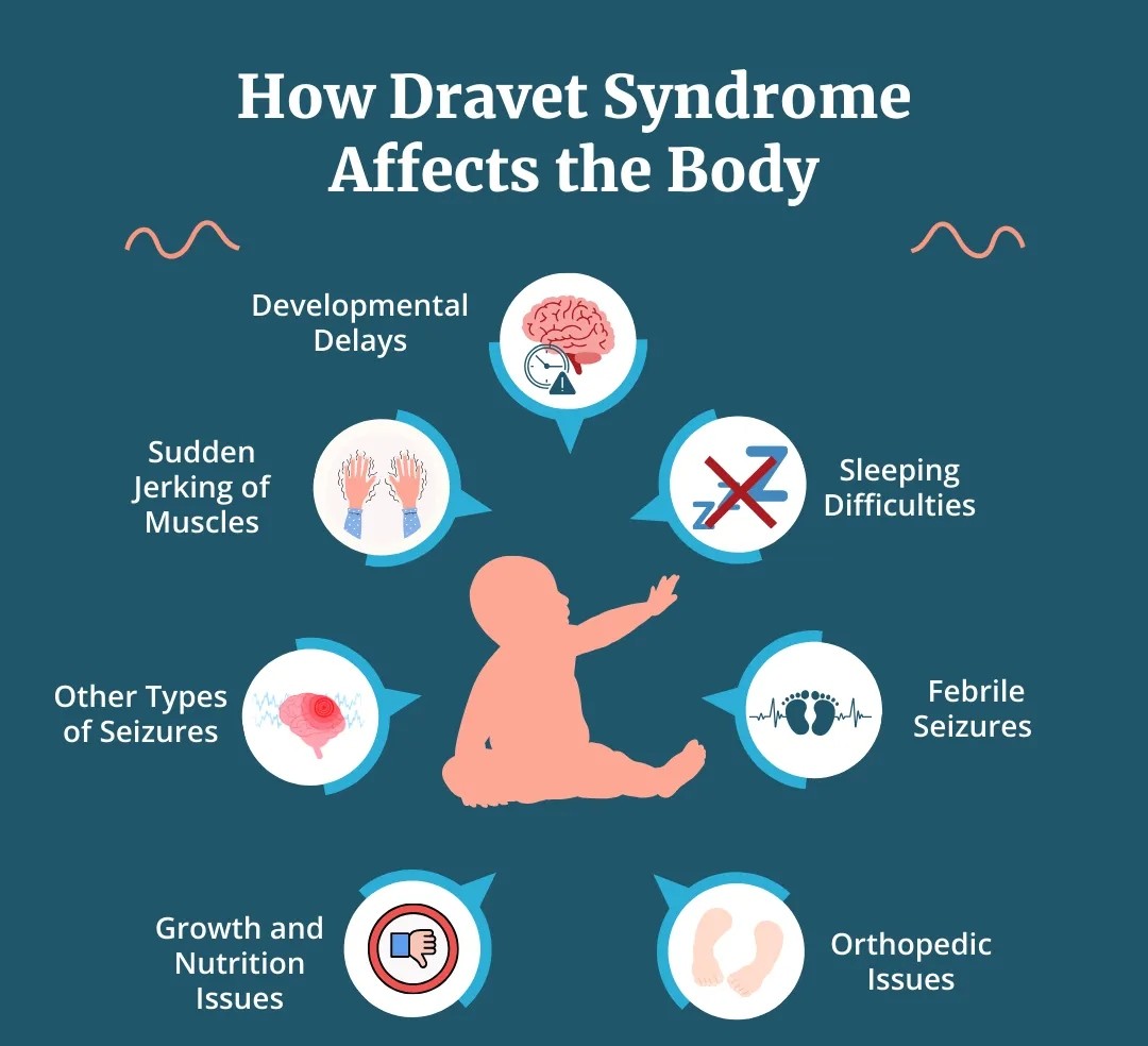 Curso: Síndrome de Dravet